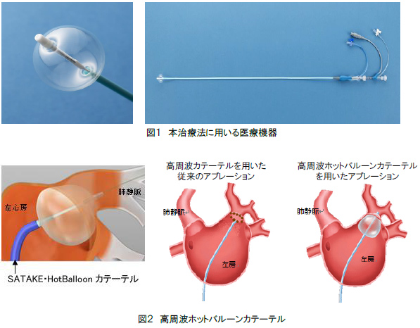 保険新技術で発作性心房細動手術 手術時間約3分の2程度で患者負担軽減 筑波大附属病院 旧 ウィークリー つくばサイエンスニュース